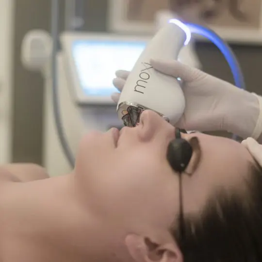 Moxi Youth Magic at Rescue Spa laser resurfacing treatment